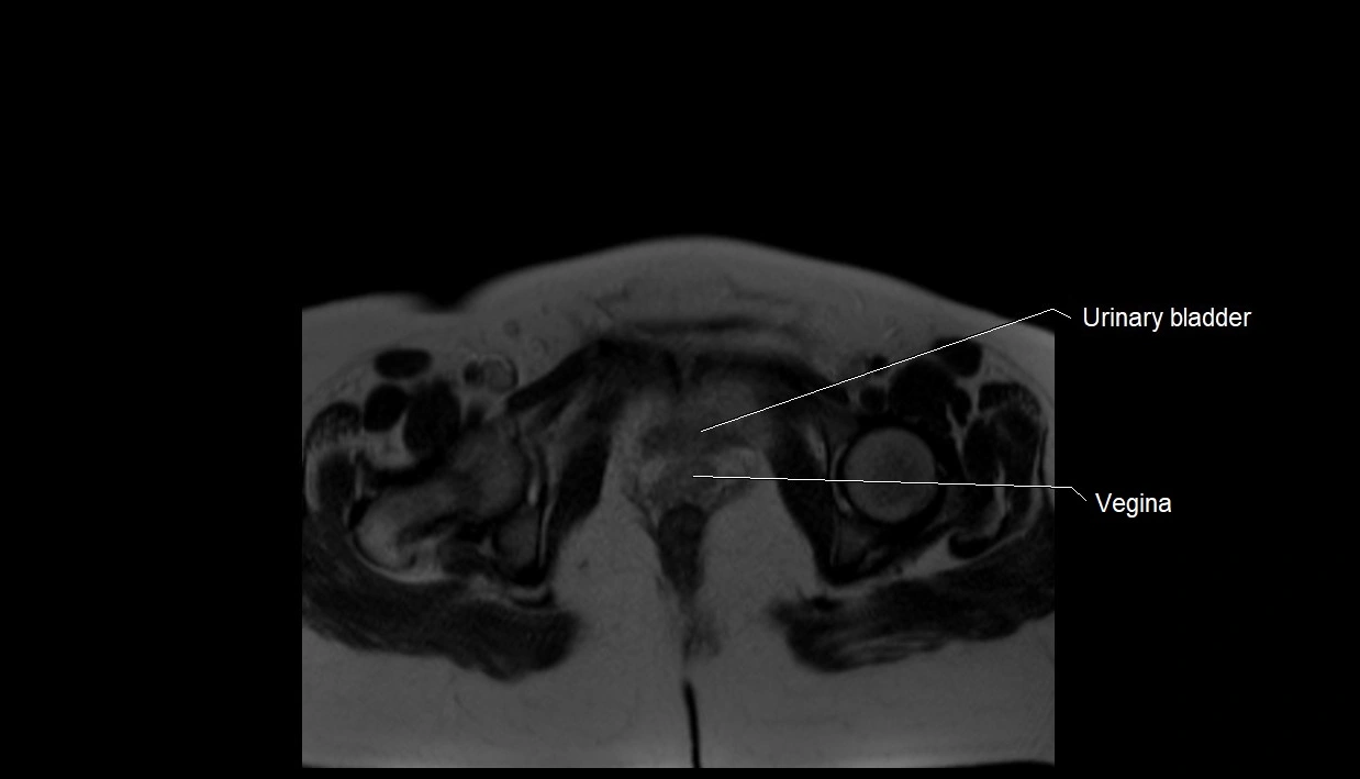 MRI fetal anatomy axial image 40.webp